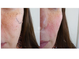 Eliminare macchie viso