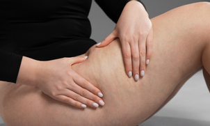 Nella maggior parte dei casi, l’opzione di trattamento più efficace è la liposuzione