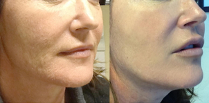 Risultati del peeling chimico per l'eliminazione di rughe