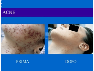 Acne farmaci per curarla definitvamente