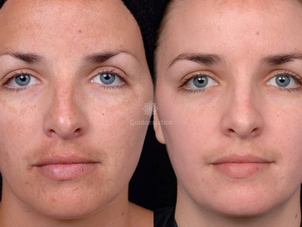 Peeling viso risultati