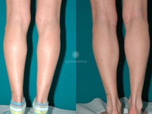 Mioplastica polpacci risultati