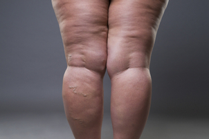 Nella maggior parte dei casi, il lipedema si manifesta negli arti inferiori
