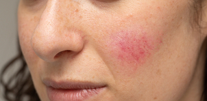 Trattamento laser per combattere la couperose