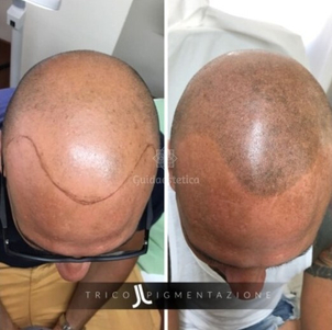 Tricopigmentazione coprire calvizie