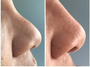 Prima e dopo rinofiller