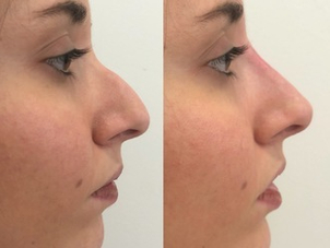 Correzione non chirurgica di una gobba del naso