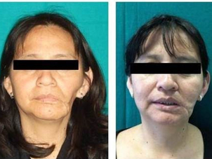 Prima e dopo intervento di chirurgia ricostruttiva