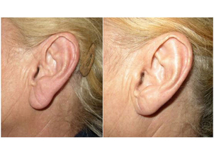 Ricostruzione del lobo