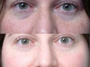 Peeling chiico acido salicilico