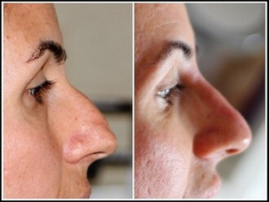 Effetti collaterali rinofiller