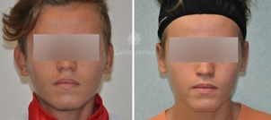 Correzione orecchie a sventola bambini