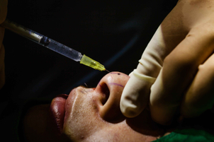 Iniezione di acido ialuronico per rinofiller