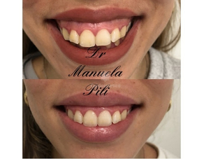 Apparecchio dentale risultati