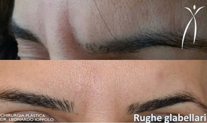 Esempio di eliminazione rughe frontali con botox