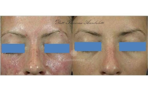 Peeling chimico dermatologo