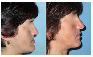 Prima e dopo intervento di chirurgia maxillo facciale