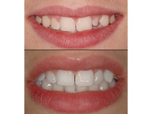 Risultati prima e dopo lo sbiancamento