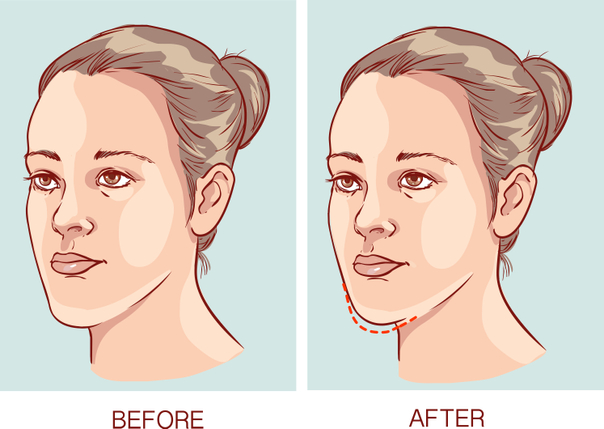 Prima e dopo chirurgia maxillo facciale