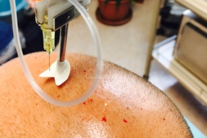 Cure per la calvizie