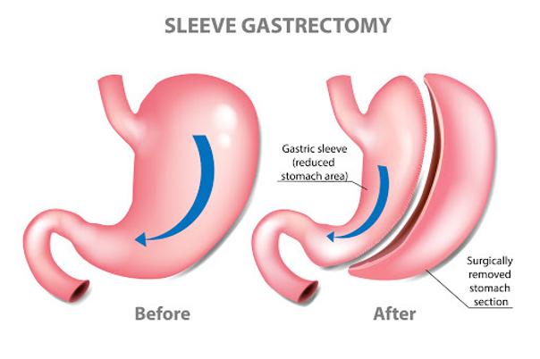 Come si esegue la sleeve gastrectomy?