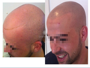 tricopigmentazione permanente