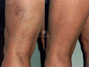 Chirurgia per eliminare varici