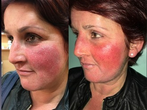 Esempio di rosacea su donna