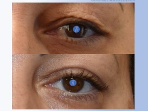 Blefaroplastica prima e dopo risultati