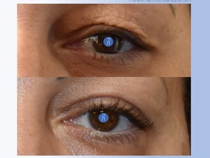 Blefaroplastica prima e dopo risultati