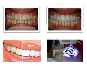 Come si svolge una seduta di fotosbiancamento