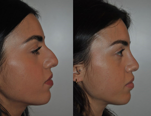 Intervento di rinoscultura