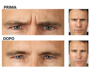Botox su volto maschile