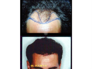 Trapianto capelli risultati e postoperatorio