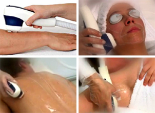 Depilazione laser completa del corpo