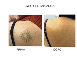 Chi può realizzare una rimozione di tatuaggio