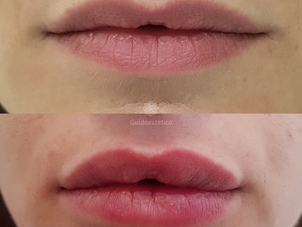 Filler labbra prima e dopo