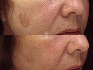 Trattamenti macchie della pelle risultati