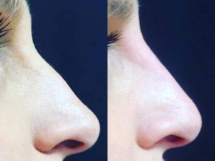 Comparazione prima e dopo rinofiller