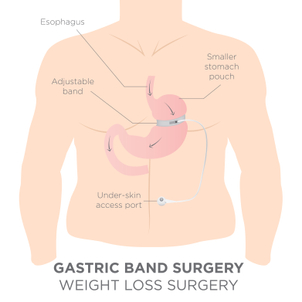 come funziona bendaggio gastrico