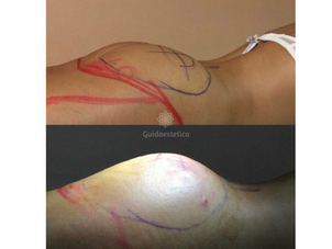 Gluteoplastica per aumentare e modellare glutei