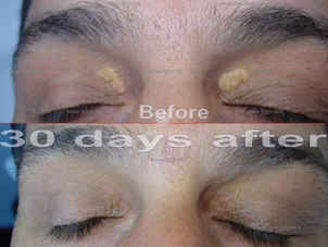 Asportazione xantelasmi risultati