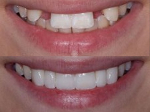 Implantologia risultati