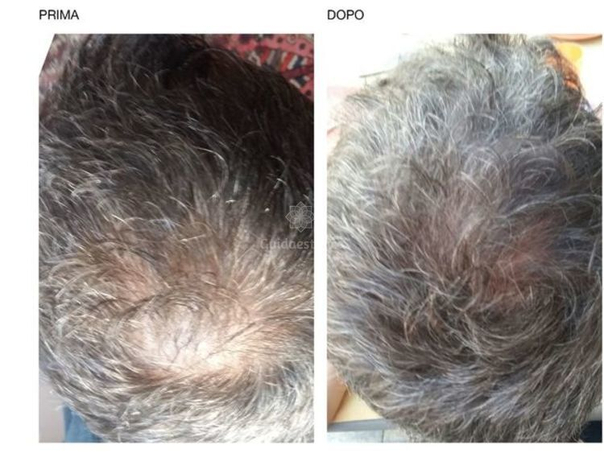 PRP per fermare la perdita dei capelli