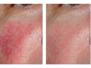 Risultati trattamento rosacea con laser