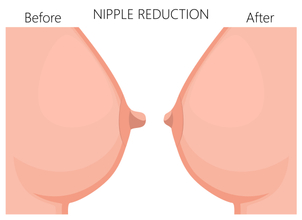 Riduzione del capezzolo