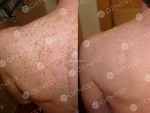 Eliminare lentiggini