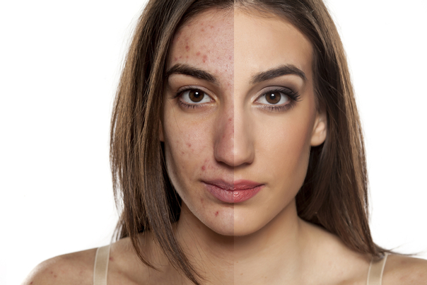Trattamento dell'acne con laserterapia