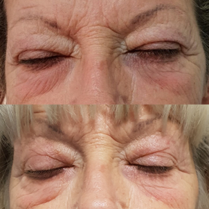 Esistono danni da plexer?