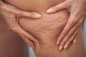 Cellulite sulle gambe